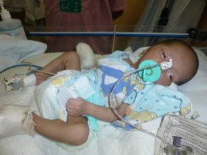 Post-operative baby in Paediatric Surgery at the Christian Medical College & Hospital (CMC), Ludhiana